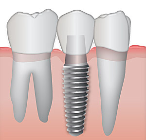 Image result for dental implant images