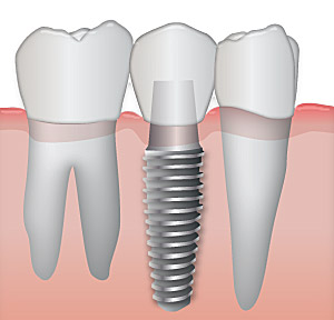 dental_implant